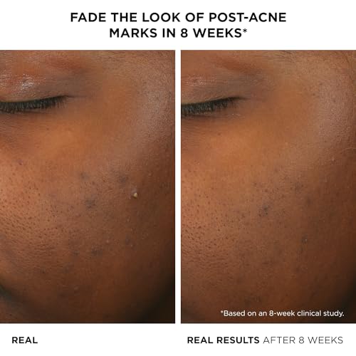 IT Cosmetics Bye Bye Breakout 2% Salicylic Acid Acne Treatment Serum, Helps Reduce Pimples in 3 Days & Fades Look of Post-Acne Marks in 8 Weeks, Facial Skin Care Product with 3% Lactic Acid - 1 fl oz