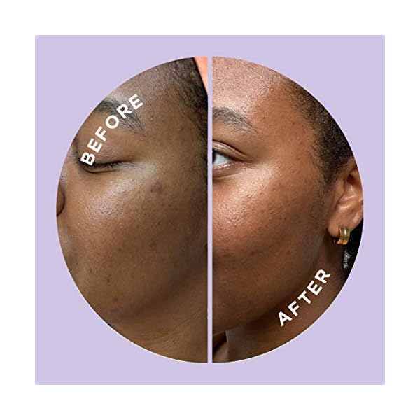 HYPERFADE-by-ZitSticka-Microdart-Patch-to-Fade-Post-Zit-Dark-Spots ZitSticka Hyperfade Acne Patches for Face - World's Most Potent Pimple Patch with Fast-Acting Microdarts - Starts Working within 2 Hours for Deep, Early-Stage Zits & Blemish - 12 Count