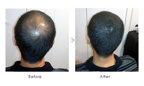 Miniatura 4 de Forila Corrector de pérdida de cabello de fibras de construcción de cabello, 0.81 oz - marrón oscuro