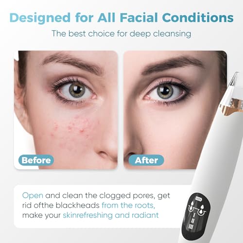 Image of Blackhead Remover Pore Vacuum, Electric Facial Pore Extractor with Silicone Probes & Vibration Tech, 3 Suction Levels Pore Cleaner for Facial Cleansing, USB Rechargeable (White)