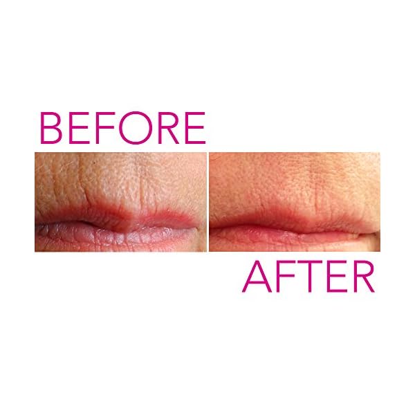 Furlesse-Lip-Sticks-Anti-Aging-Patches-for-Lip-and-Smile-Line-Wrinkles-120-Count Furlesse Lip-Sticks Anti-Aging Patches for Lip and Smile Line Wrinkles, 120 Count