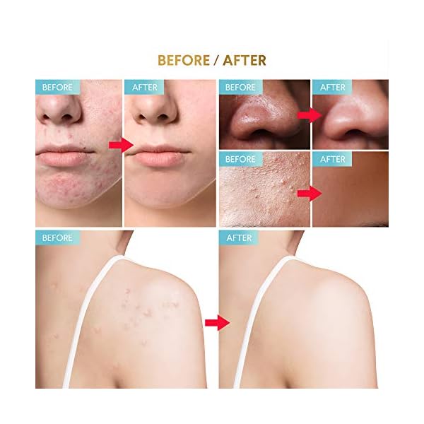 Glossiva-Drying-Lotion-Acne-Spot-Treatment-Dries-Out-Pimples-Blemishes-Zits-and-Clogged-Pores-Overnight-Solution-Powerful-Ingredients-123-Fl-Oz Glossiva Drying Lotion â Acne Spot Treatment, Blemish & Pimple Drying Solution with Overnight Results â 1.23 Fl Oz