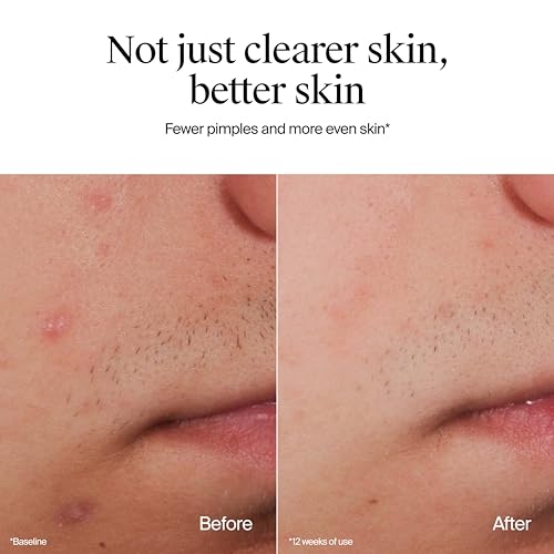 Neutrogena Oil Free Acne Face Wash, Fragrance Free, 9.1 fl oz - image 6