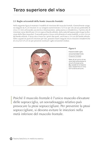 Tossina Botulinica In Medicina Estetica. Protocolli Iniettivi E Gestione Delle Complicanze - 2