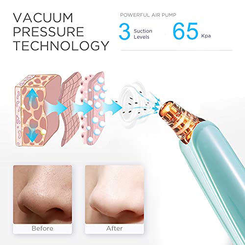 Image of Blackhead Remover Pore Vacuum Cleaner - Upgraded Facial Pore Cleaner - Electric USB Pore Vacuum with 5 Probes - Upgraded Blackhead Suction Tool - Blackhead Remover Kit