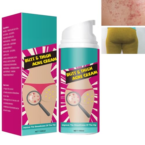 Crema de Acné de Cadera,Crema para Eliminar el Acné en los Glúteos,Crema para el Acné,Butt Acne Clearing Spot Tratamiento Crema,Tratamiento de Glúteos,Tratamiento de Gluteos Acné,Acne Espalda