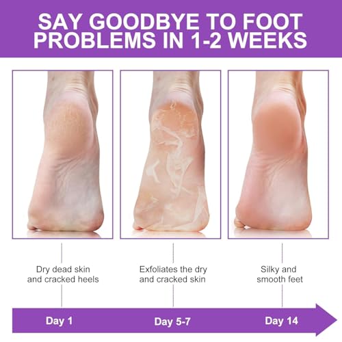 Image of Deep Cleansing Foot Mask for Dry Cracked Feet | FREE Natural Ginger & Bamboo Vinegar Patches for Toxin Removal, Pain Relief, Better Sleep & Circulation for Men & Women | (Foot Mask & Foot Soak)
