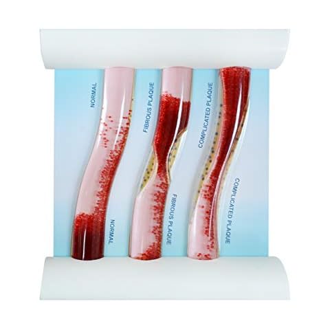 Medarchitect Low-Density Lipoprotein LDL Blood Vessel Model for Medical Patient Doctor Teaching Cover