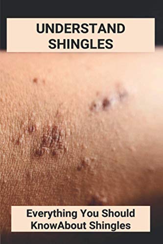 Understand Shingles: Everything You Should Know About Shingles: Shingles Topical