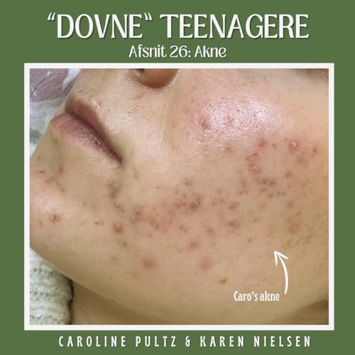 26 - Akne p&aring;virker ikke kun huden