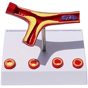 Anatomie Model, Educatief Model Anatomie Atherosclerose Model Trombus Trombose Vasculair Model Arterieel Bloedvat…