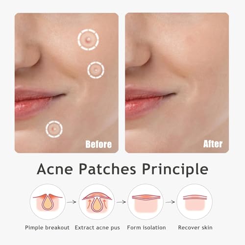Dazzlook Ultra Pimple Patches - Hydrocolloid Acne Patch for Covering Zits and Blemishes Breakouts Y2K Spot Acne Dots Stickers for Face and Skin Day and Night Use - image 5
