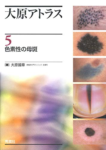 大原アトラス5 色素性の母斑