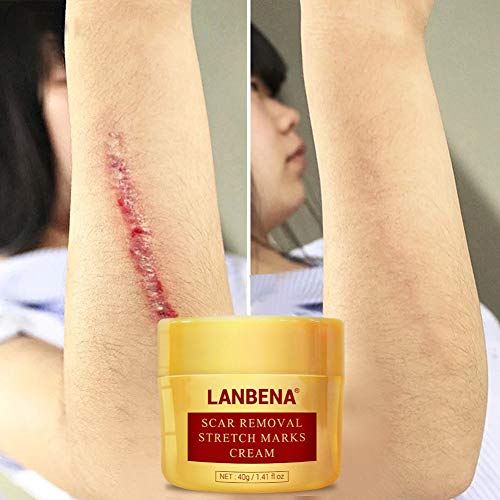 Preisvergleich Produktbild Allbestaye Narbenentfernung Creme Narbencreme für Aknenarben Dehnungsstreifen Surgical Scars Brennen Narben Scar Fade Cream Narbensalbe Behandeln Sie neue und alte Narben