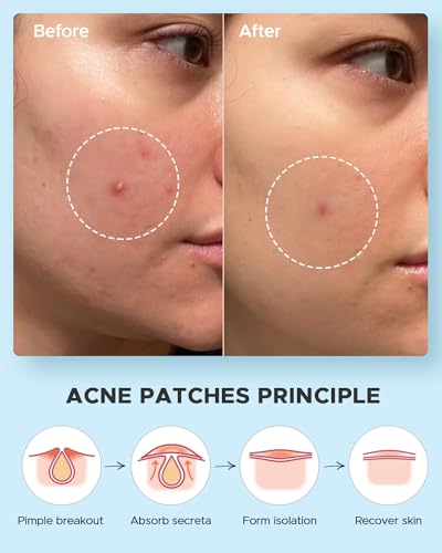 image for LitBear Acne Pimple Patches- Day and Night 4 Sizes 180 Dots Thin & Thi