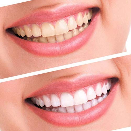 Branqueador Dental Ultra Whiteness Kit 10 Seringas 22% Led