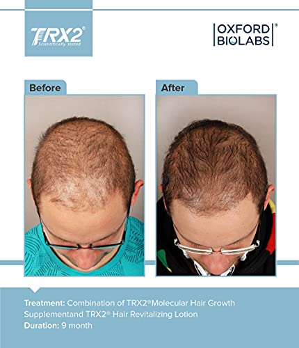 TRX2 Hair Growth Supplement - Healthy Hair - Clinically Proven Results of Thicker, Fuller Hair - Stop Hair Loss for Men and Women - Biotin & Selenium & Zink - Vegetarian - 1 Month Supply - Image 6