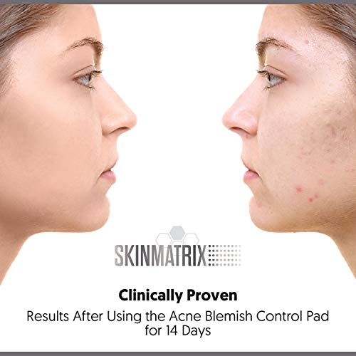 Yishiqianti-Blemish Acne Control Pads- Contains Salicylic, Lactic, & Mandelic Acid. Clears Away Clogged Pores, Whitehead & Blackhead Pimples. Eliminates Acne For Face & Body. #TOP2