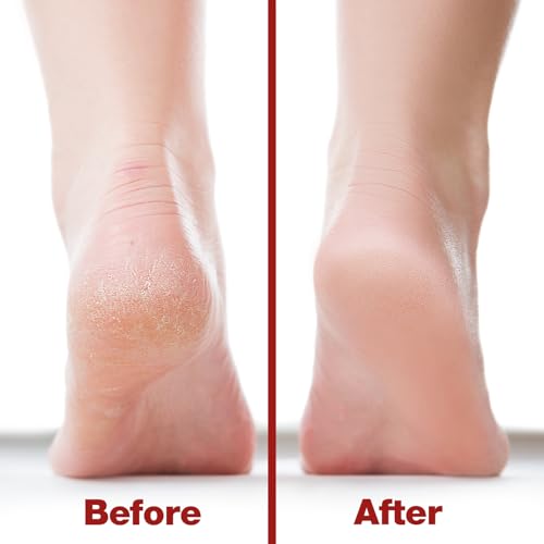 Image of Probelle Double Sided Multidirectional Nickel Foot File Callus Remover - Immediately Reduces calluses and Corns to Powder for Instant Results, Safe Tool (Red)