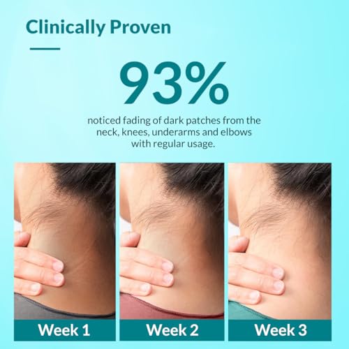 FIXDERMA Nigrifix Cream for Acanthosis Nigricans with Lactic Acid | Dermatologist Tested Retinol Cream | Useful for Dark Body Parts like Neck, Ankles, Armpits & Elbows –3.52 FlOz