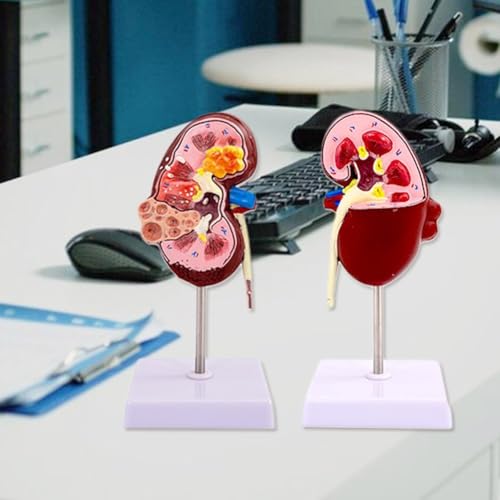 Modèle de pathologies rénales anatomique double face pour bureau médical - 4