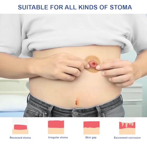 6 Stück Stoma Barriereringe 2mm Stomabeutel Stoma Barrier Tapes Absperrstreifen Selbstklebende Stomaversorgung für Kolostomiebeutel