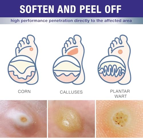 Image of Dr. Luke Foot Corn Removers for Toes & Finger: Deep Corn Removal for Feet & Hand - Fast Acting 17% Salicylic Acid Corn Removers for Feet Hand Corn, Plantar Wart, Common Wart - 0.5 Ounce (Pack of 1)