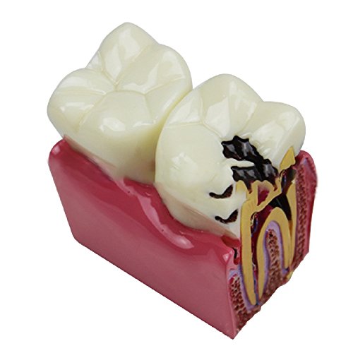 Pevor New Dental Teeth Model Dental Caries Tooth Model Patient Education Teeth Model 6 Times Caries