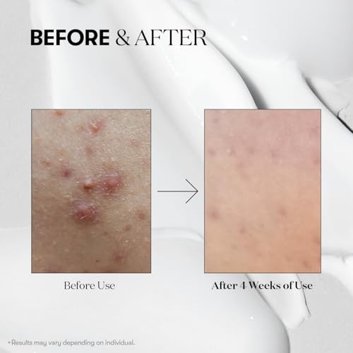 VT-COSMETICS-CICA-Reedle-Shot-100-Daily-Night-Exosome-Microneedling-Serum-Centella-Asiatica-Hyaluronic-Acid-Propolis-Soft-Skin-Regeneration-Glass-Skin-Korean-Skin-Booster-169Fl-Oz-50ml