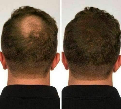 YGH Hair Building Fibers, Conceals Hair Loss in 15 Seconds, 100% Undetectable, 0.98 oz / 28g Bottle - Image 5