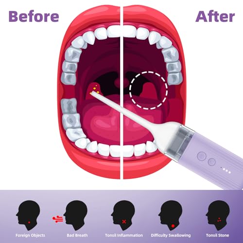 Image of Electronic Tonsil Stone Remover, Waterproof Vacuum Tonsil Stone Removal Kit with 4 Levels Suction Mode - Fight Bad Breath Oral Irrigator, Rechargeable Tonsil Cleaner - Hassle-Free Instant Suction