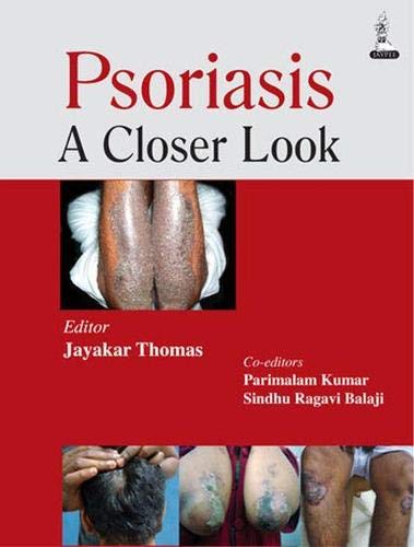 Psoriasis: A Closer Look