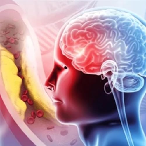 TIEMPO CEREBRAL Y EMBOLIA