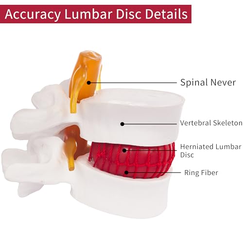 Ruiishunyy Human Anatomical Lumbar Disc Herniation Model, 1.5 Times Life Size Lumbar Vertebrae Disc Herniation Model, Portable Lumbar Spine Model for Medical, Teaching and Demonstrating
