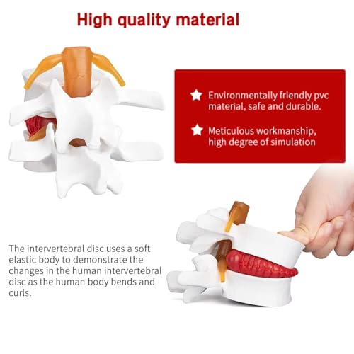 Image of Herniated Disc Spine Model, 1.5X Life Size Lumbar Spine Anatomy Model for Teaching, Chiropractic Demonstration, Medical Learning and Patient Education (1pc Spine and Disc Model)
