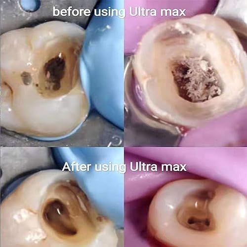 Equipo Dental Endo Irrigador, Activador Dental Endo Ultra Irrigador con 120 Puntas, Activador de Odontología Limpieza de Dientes Instrumento Dental Limpieza Endo