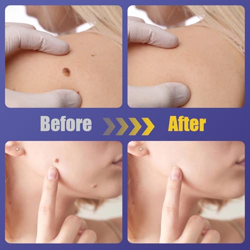 image for WABRINY Maximum Strength Wart Remover Patches, Fast & Easy Operate Hyd