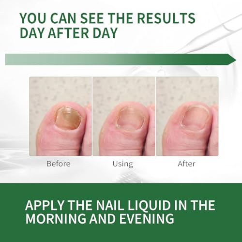 image for Calpol Toenail Fungus Treatment Extra Strength,7Days Nail FungusTreatm