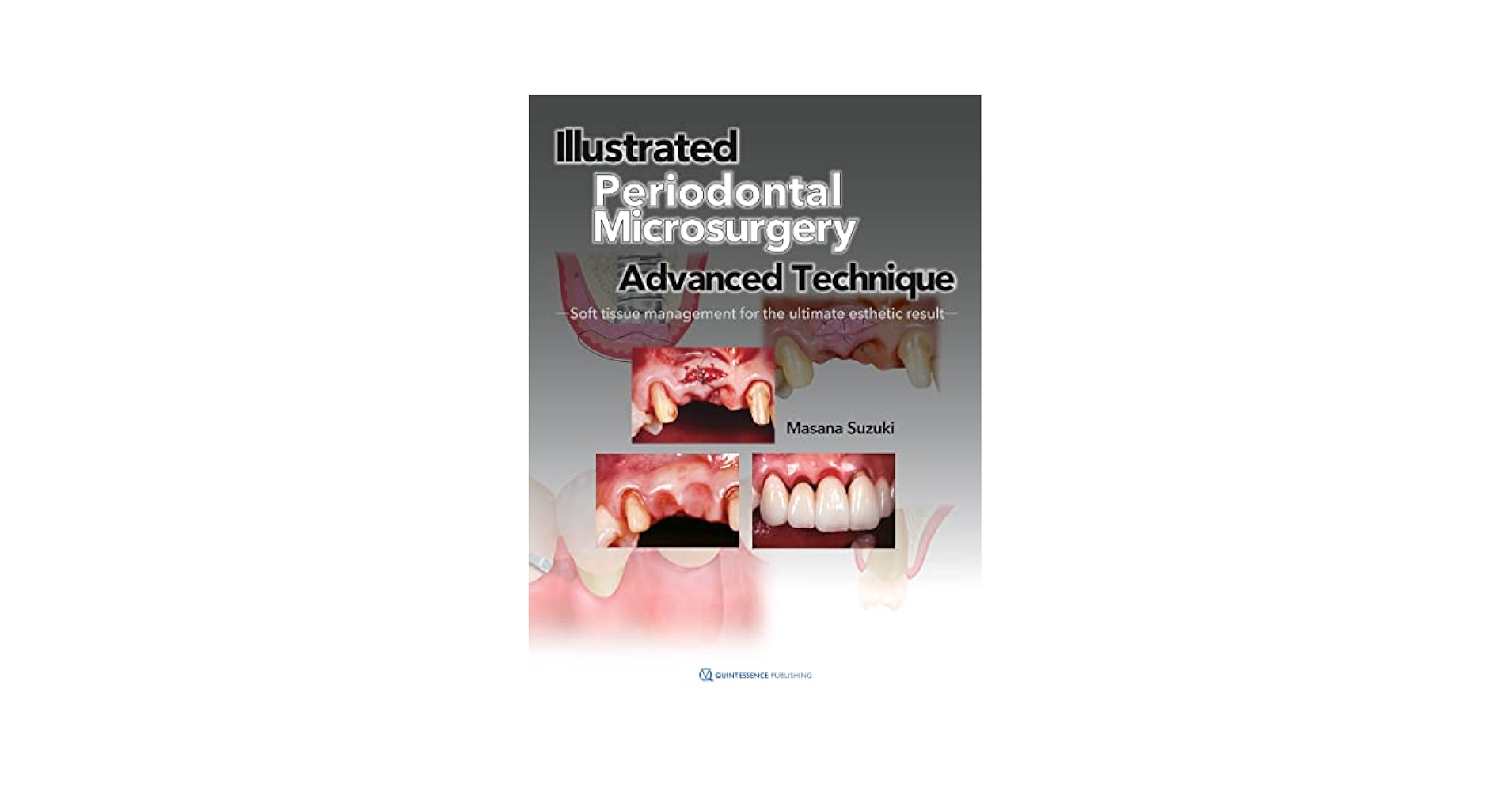 Illustrated Periodontal Surgery 西川雄島著 Illustrated Periodontal Microsurgery: Advanced Technique