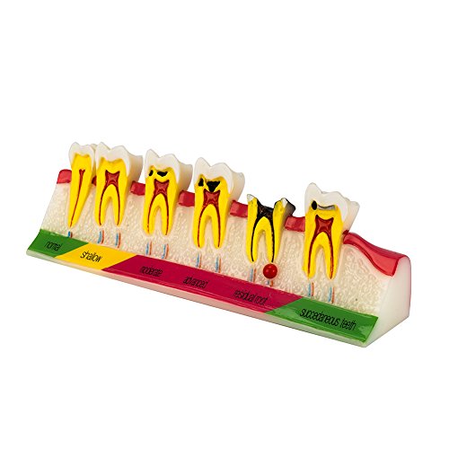 Easyinsmile Dental Caries Developing Model Tooth Typodont Teeth Model