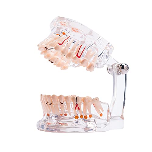 Easyinsmile Dental Pathology Model Half Implant Tooth Model for Dentist Studying Researching and Patient Education