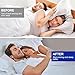 Imagen de Set of 4 Anti-Snoring Splints