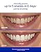Supersmile Professional Teeth Whitening System - Whitening Toothpaste and Accelerator - Whitens Up to 7 Shades