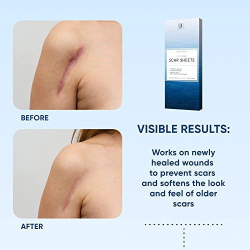 Silicone Scar Removal Sheets - Breathable Reusable & Waterproof Keloid Scar Removal Patches Caused By C-Section, Surgery, Burn, Acne, Stretch Marks Healing Alternative To Gel, Tape & Cream (4 Sheets) #TOP4