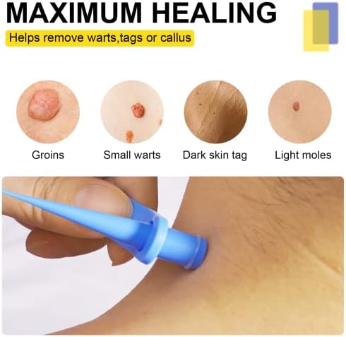 Skin Tag Remover, Painless Skin Tag Removal Kit for Acne, Wart and Blackhead Remover, Suitable for Most Skin Types Advanced Formula Acne Remover Safe Painless & Fast Effective For Tags (2mm - 8mm)Blue