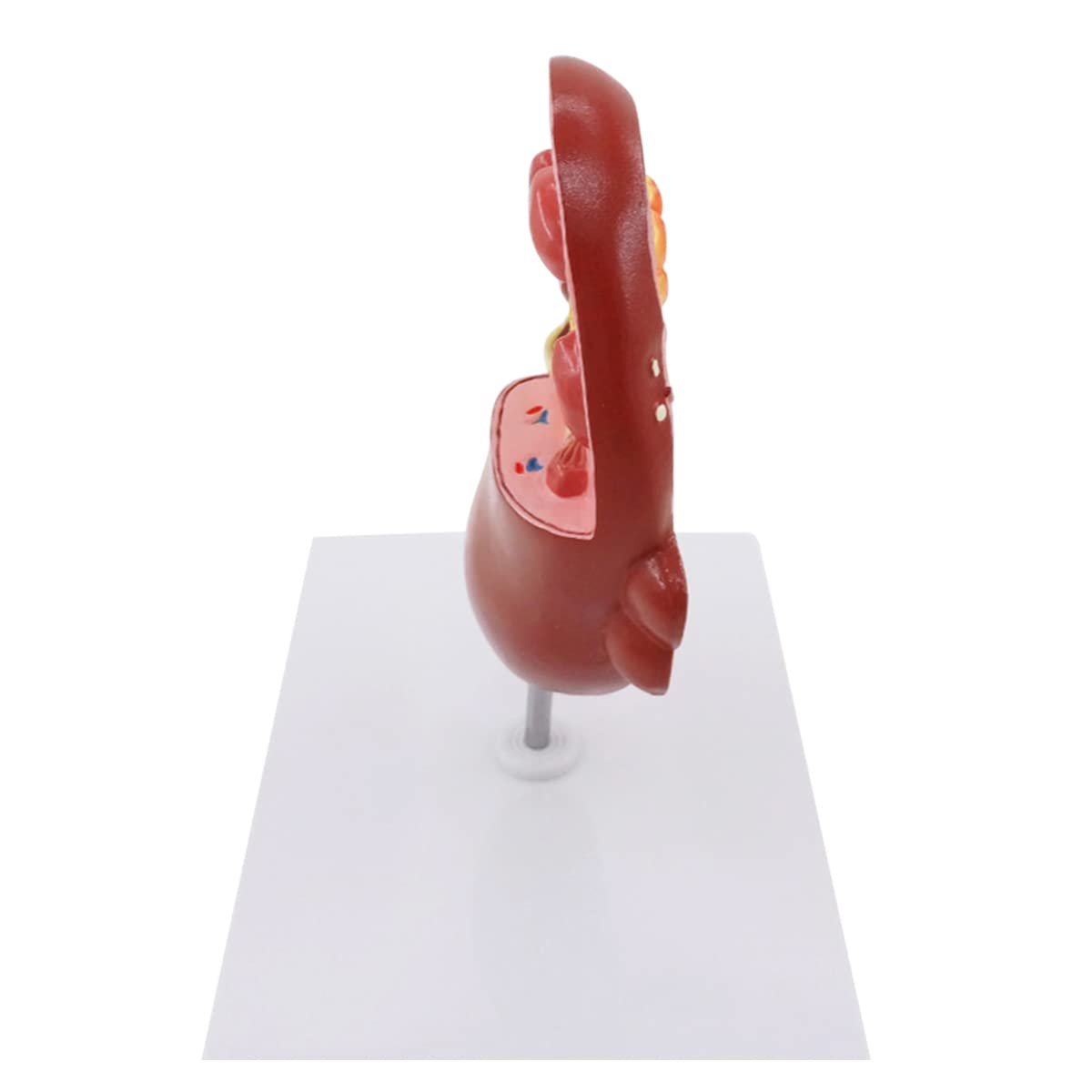 Pathologisches Modell, menschliches Nierenläsionsmodell, Anatomie, pathologisches Steinorgan, Nierensteine, Urologie, Nierenmodell für medizinische Lehr-/Bildungsbedarf