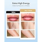 INNZA IPL Hair Removal with Ice Cooling Care Function for Women,Long-Lasting Results,999,999 Flashes Painless IPL Hair Remover, Hair Removal Device for Armpits Legs Arms Bikini Line - Image 4