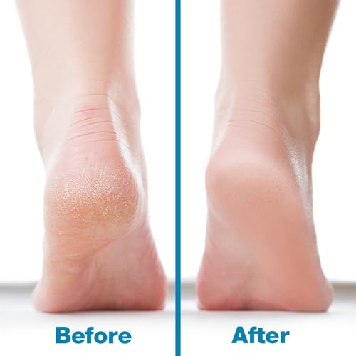 Image of Probelle Double Sided Multidirectional Nickel Foot File Callus Remover - Immediately Reduces calluses and Corns to Powder for Instant Results, Safe Tool (Blue)