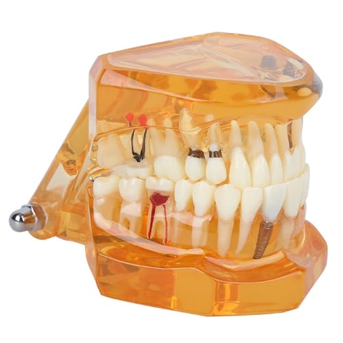 Natudeco Zahnmodell Dentalmodell Zahnkrankheits-Lehrmodell Dental Maxillary Overdenture Model Minderwertiges Präzisionsimplantat Demo with 4 Implantats for Zahnarztlaborklinik Zahnarztköpfe