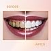 Fake Teeth SmileShaperVeneers